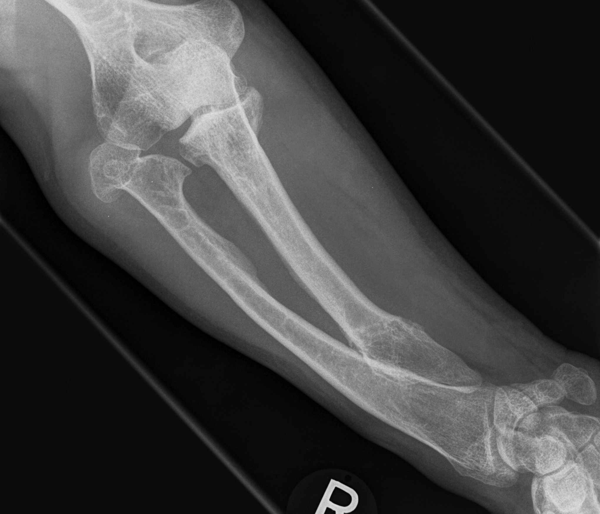 Osteochondromas Forearm 2